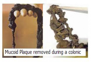 tarmsköljning tarmplack colonic