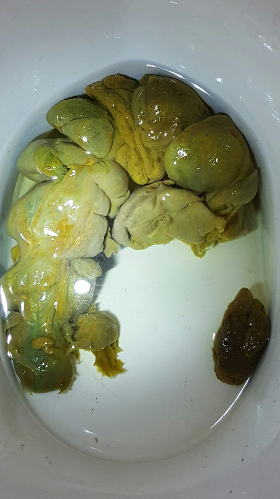 grönt tarmplack i toalett Tarmrening 