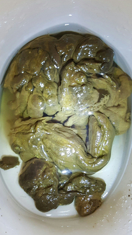 brunt tarmplack i toalett Tarmrening 