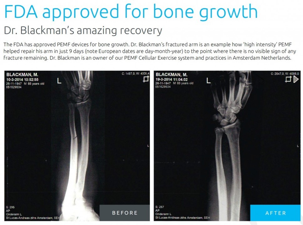 FDA har godkänt PEMF för läkning av benbrott.