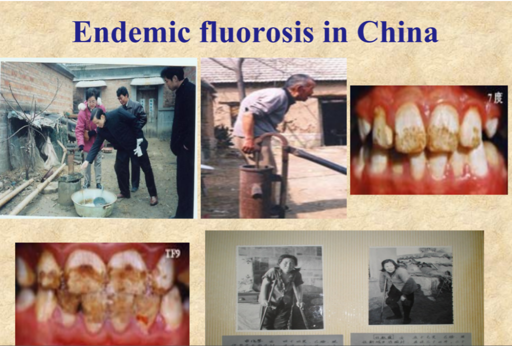 Endemic Fluorosis. Kina. Skeletal Fluorosis.