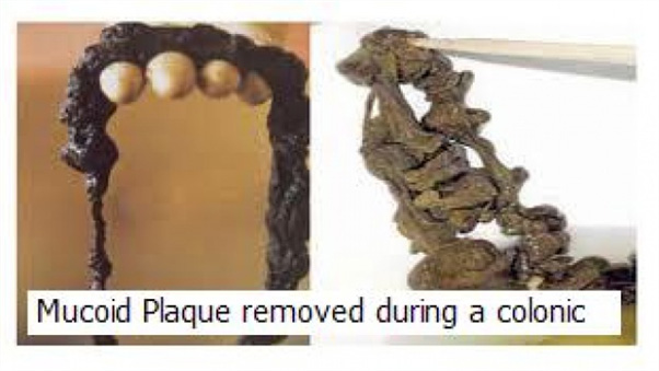 Tarmplack som kom ut under en tarmsköljning.