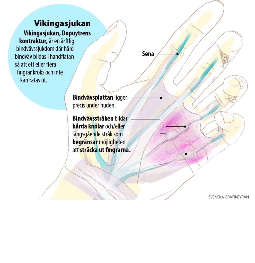 Vikingasjukan. Bild med beskrivningar av symptomen.