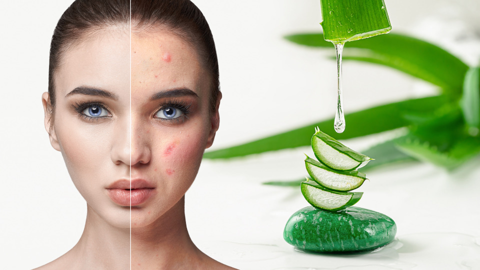 kvinna får bättre hud i ansiktet efter aloe vera gel.